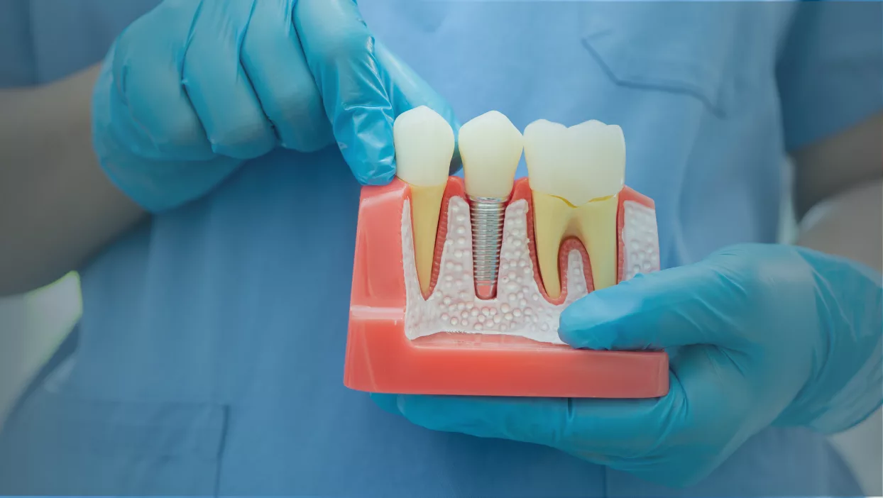 Root-Canal-Awareness